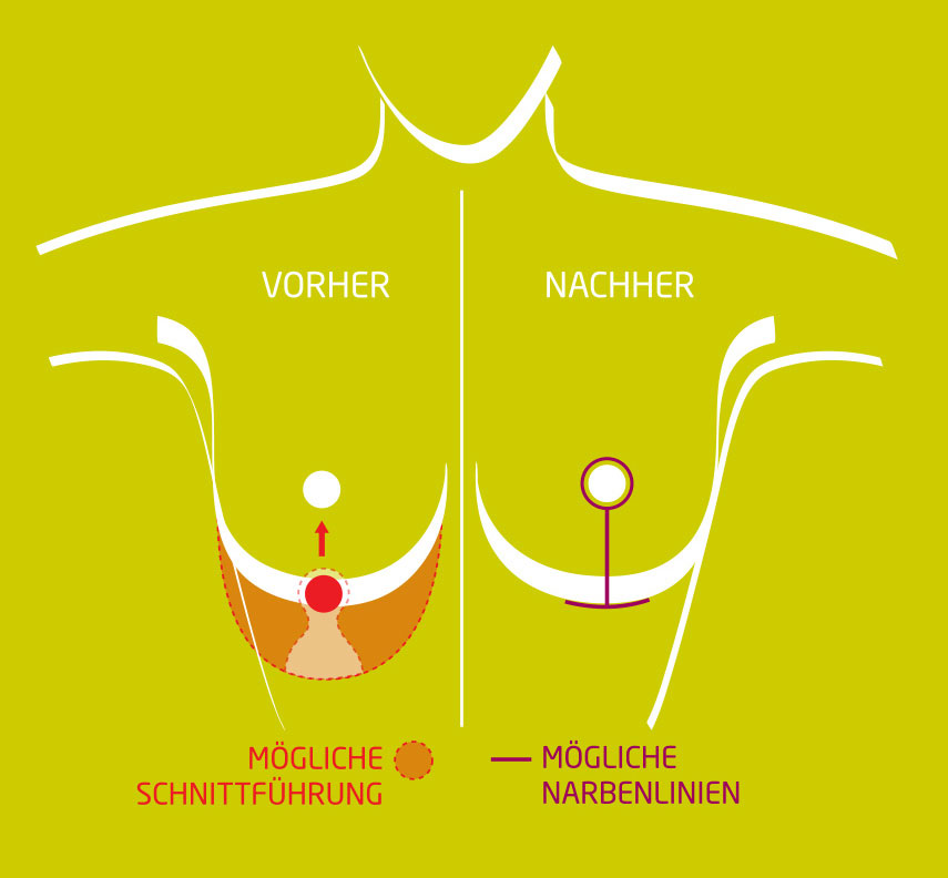 Bruststraffung-technik-narben