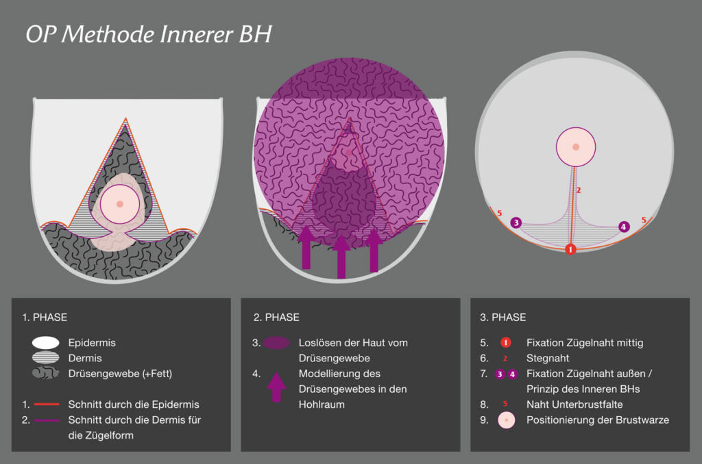 Visualisierung der OP-Methode Bruststraffung mit Innerem BH