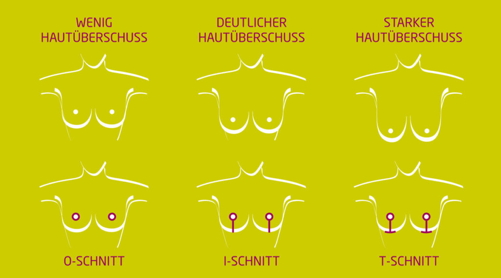 bruststraffung-methoden-techniken-schnittführungen