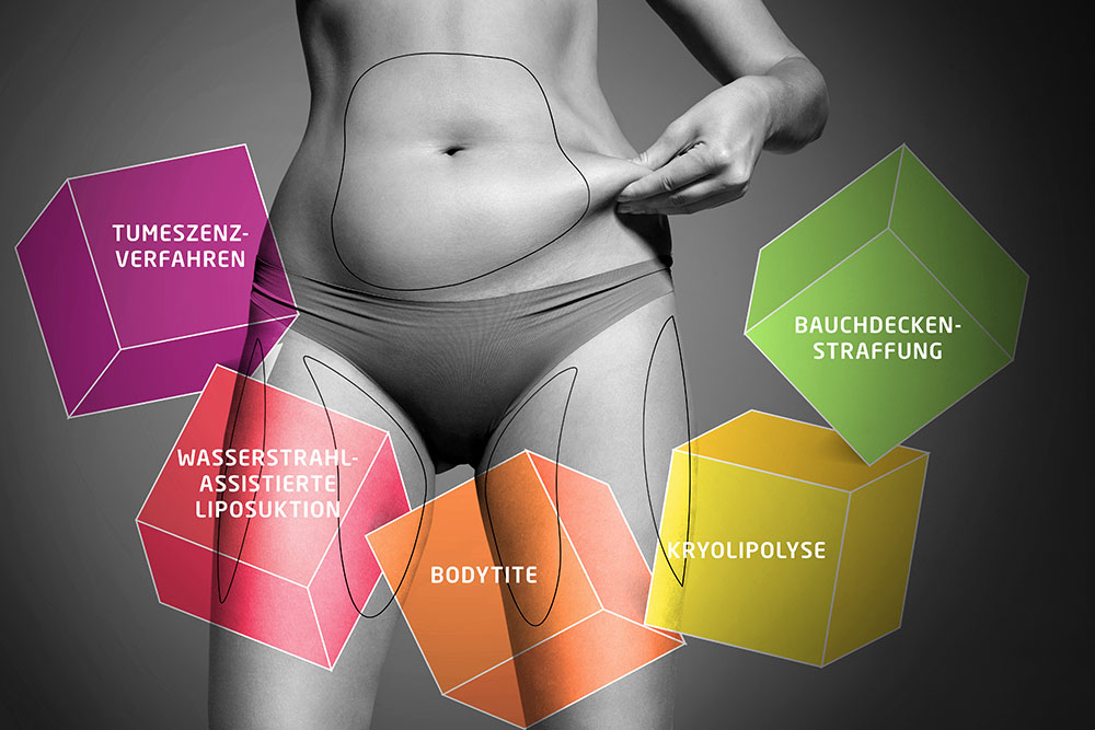 Fettabsaugung-Liposuktion-Bauchdeckenstraffung-Methode