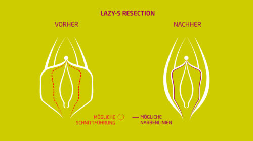 Schamlippenverkleinerung-Methode-LS