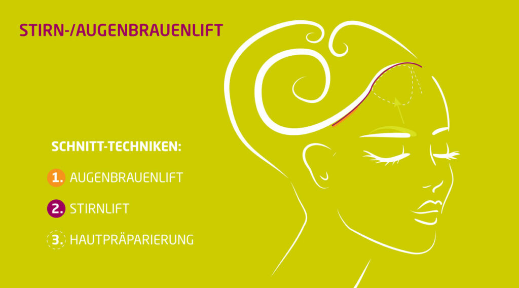 Augenbrauenlifting-facelifting-stirnlifting-koeln