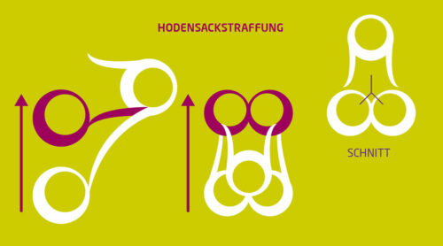 hodensackstraffung-koeln