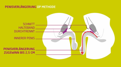 penisverlaengerung-op-koeln