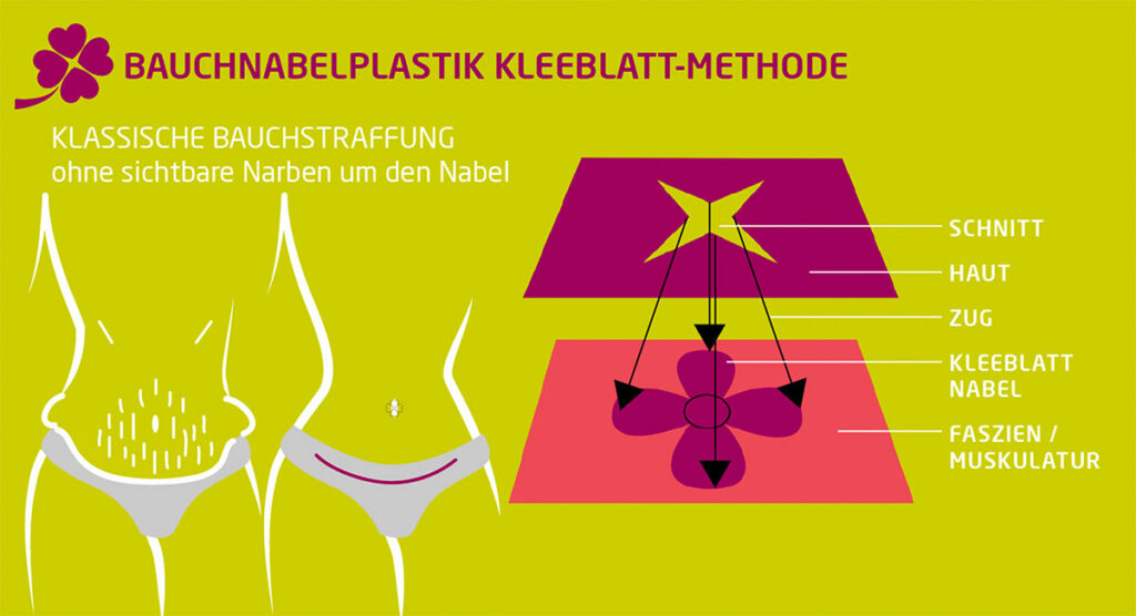 Bauchdeckenstraffung-Bauchnabelplastik-methoden