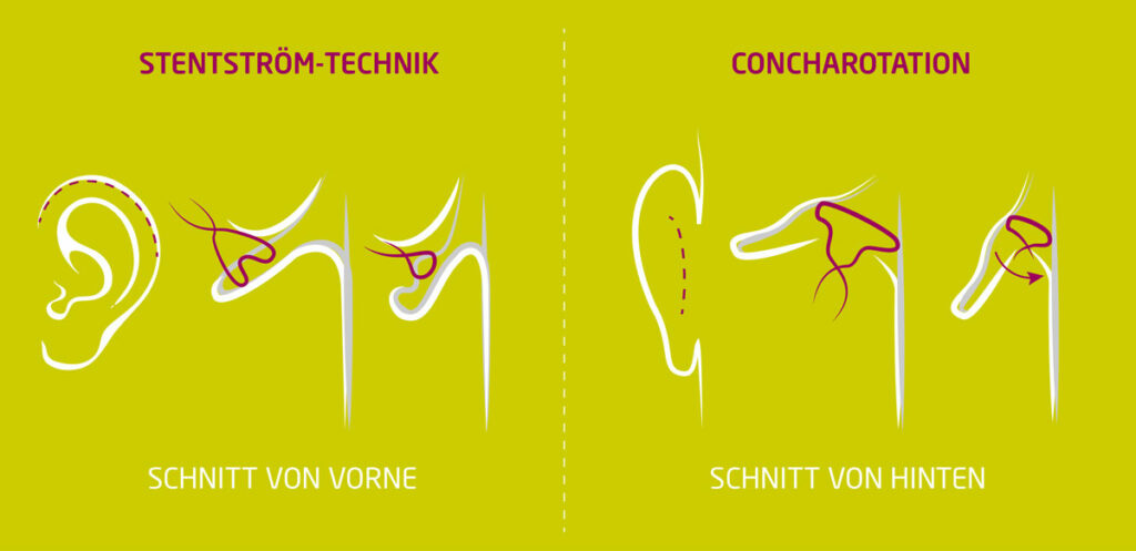 Ohren anlegen-ohrenkorrekter-koeln