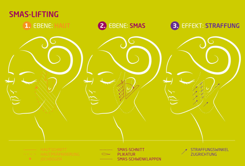 facelifting-gesichtsstraffung-minifacelift-koeln