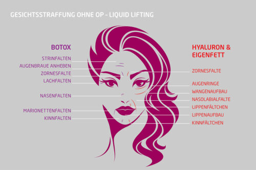 Eigenfett-faltenunterspritzung-hyaluron-botox-koeln