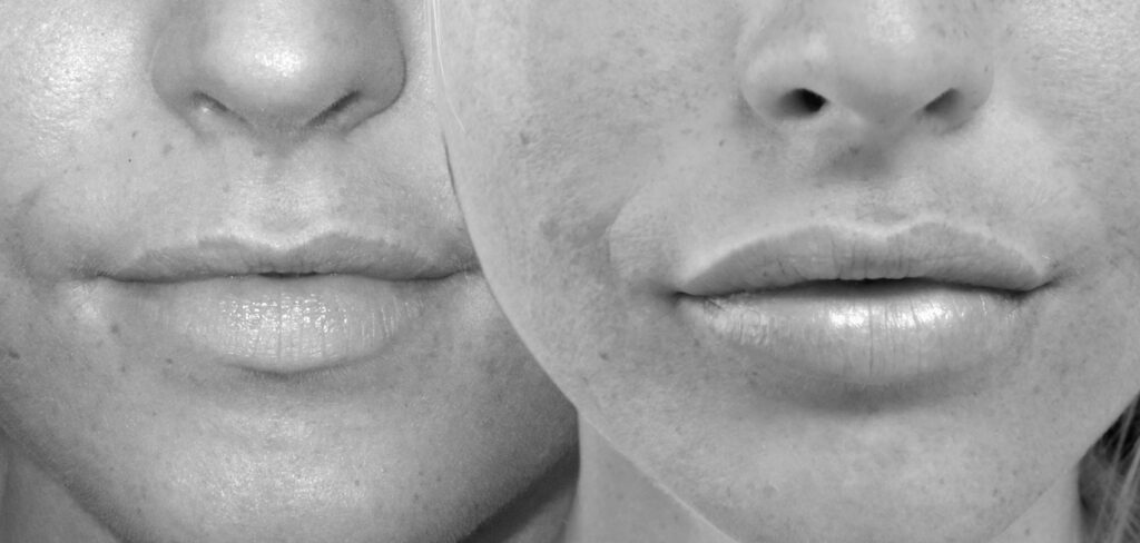 Lippenunterspritzung-lippen vergrössern-koeln