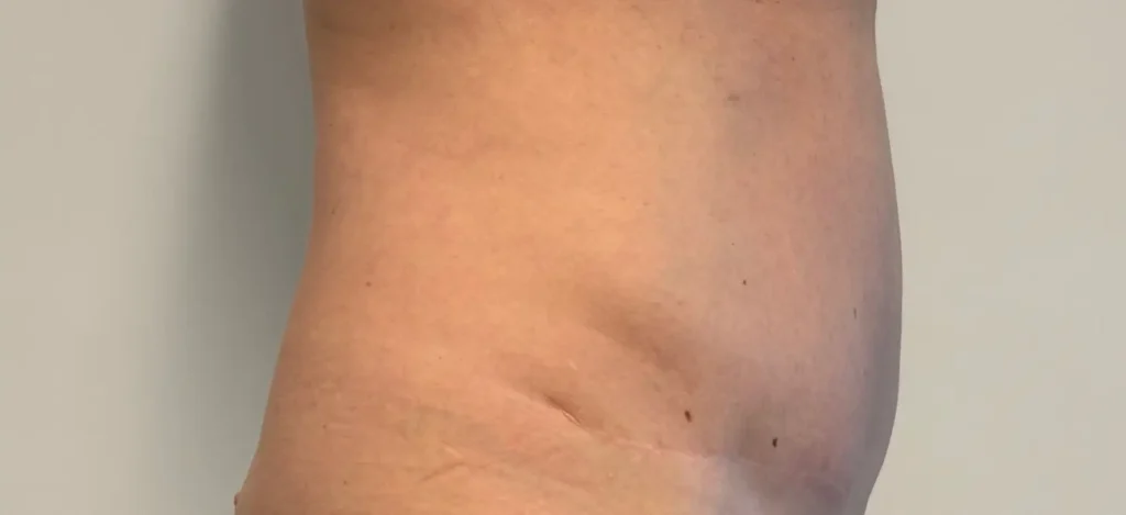 Narben nach der Bauchdeckenstraffung seitliche Ansicht